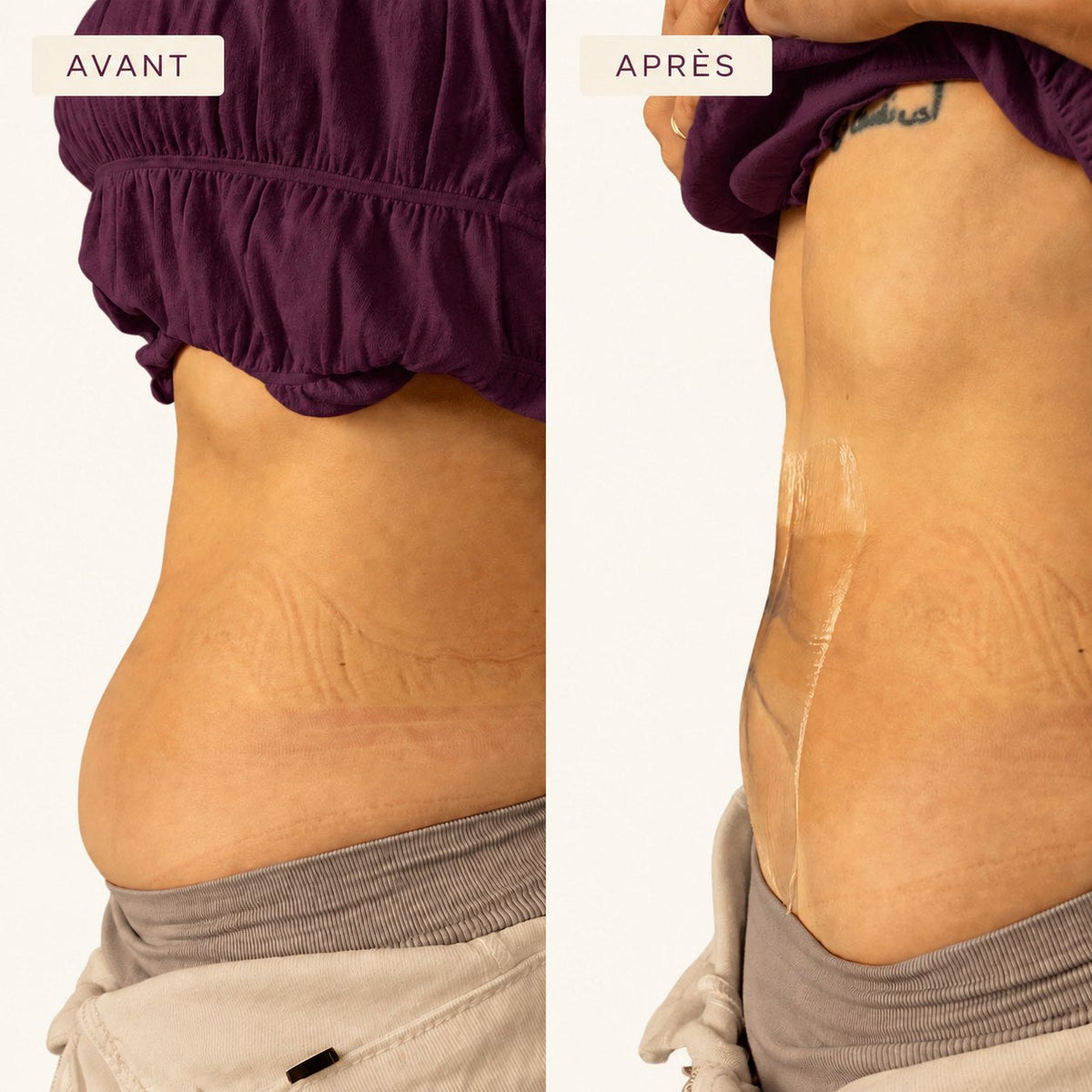 Body Lift Ventre — avant et après sur le ventre