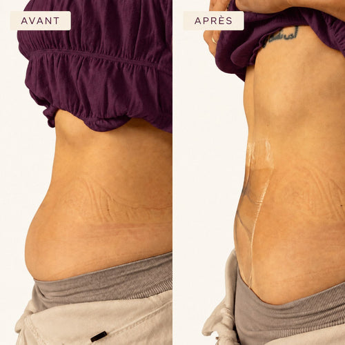 Body Lift Ventre — avant et après sur le ventre